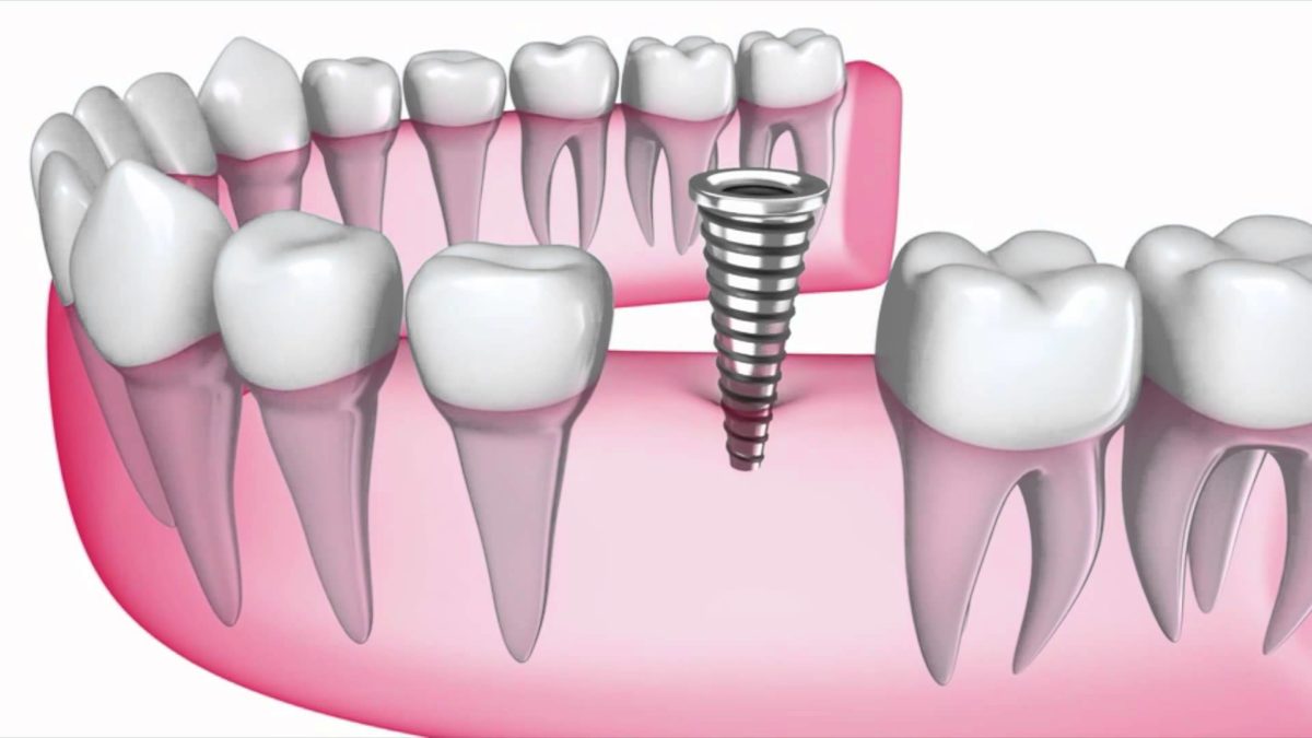 Защо пациентите предпочитат базални зъбни импланти?